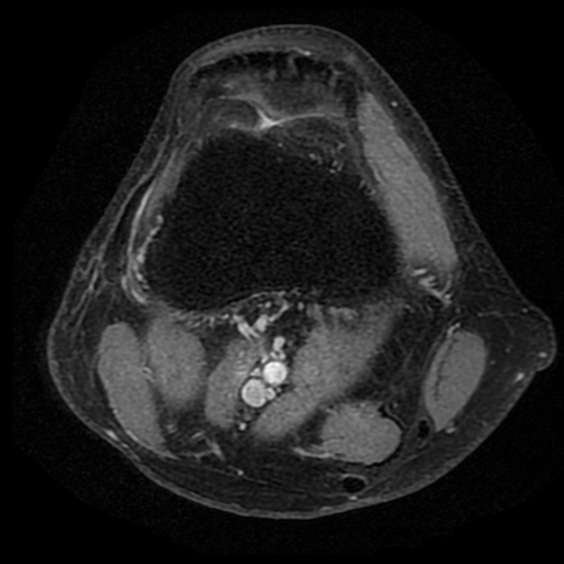 Figure 4 for case Third head of the gastrocnemius